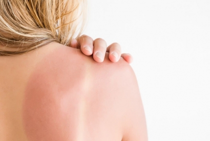 Gut gegen Sonnenbrand